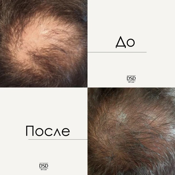 DSD Crexepil De Luxe Classic №3.4.2 - Лосьон для стимуляции роста волос и снижения их выпадения 