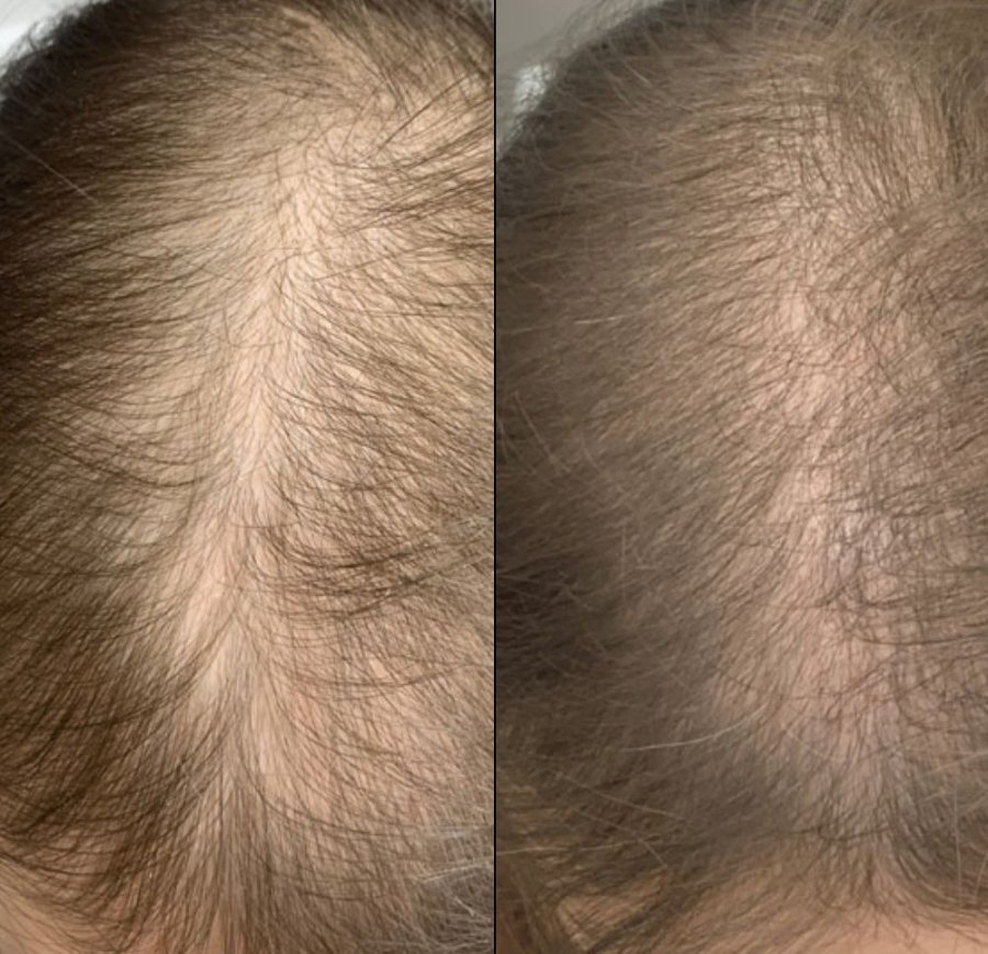 DSD Capixyl + Placenta Shok De Luxe Lotion № 3.4.4 - Лосьон Капиксил + плацента шок 