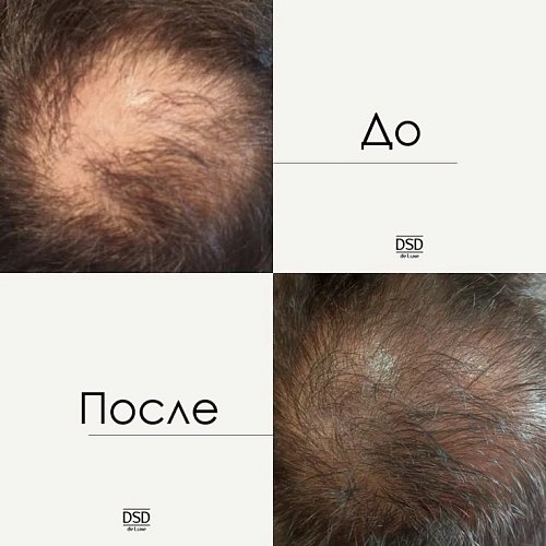 DSD Crexepil De Luxe Classic №3.4.2 - Лосьон для стимуляции роста волос и снижения их выпадения 